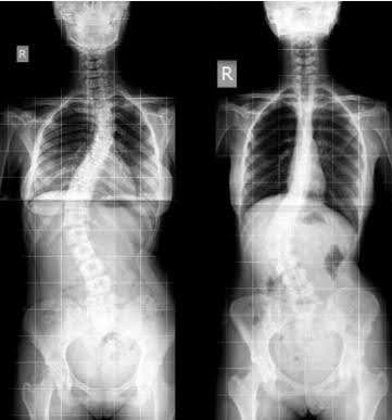 Scoliosis